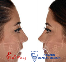 Slider image (3) Cancun Dental Design